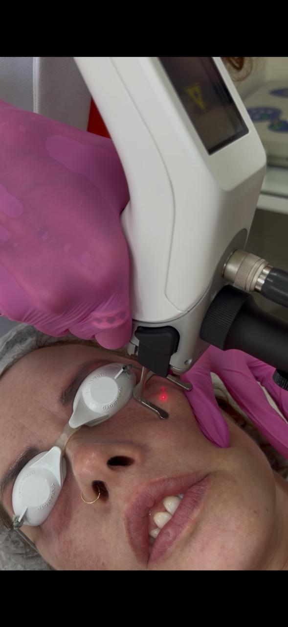 Laser de CO2